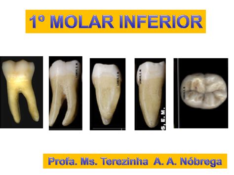 Primeiro Molar Inferior Anatomia Resumo De Anatomia Dental Off