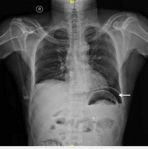 X Ray Of The Chest And Abdomen Showing Gas Under The Diaphragm Download Scientific Diagram