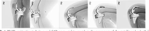 Figure 2 From In Vivo Kinematic Analysis Of Cruciate Retaining Total