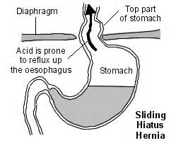 Hiatus (Hiatal) Hernia – Symptoms, Causes, Pictures, Diet and Surgery