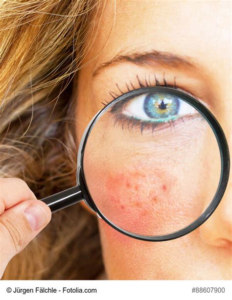 Entstehung Symptome und Auslöser Rosacea Info