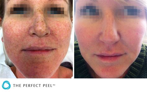 The Perfect Peel® Renew Medical Aesthetics Cheshire Clinic