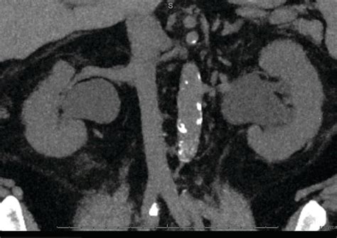 Endoscopic Management Of Ureteroenteric Strictures Abdominal Key