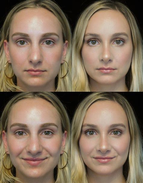 The Complete Guide To Rhinoplasty Rhinoplasty Rhinoplasty Surgery