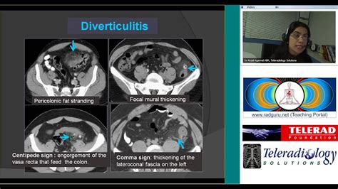 Ct Presentation On Acute Abdomen By Dr Anjali Agrawal Youtube