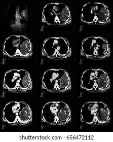 Computed Tomography Ct Scan Chest Abdomen Stock Photo