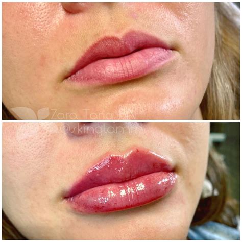 Lip Filler Before And After 2 Syringes Botox Lips Lip Fillers Cheek