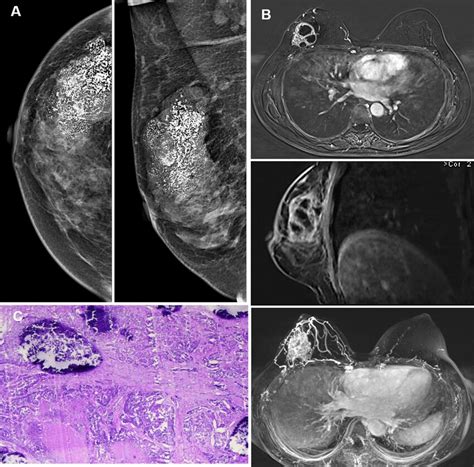 57y Female Right Invasive Ductal Breast Cancer With Calcification And Download Scientific