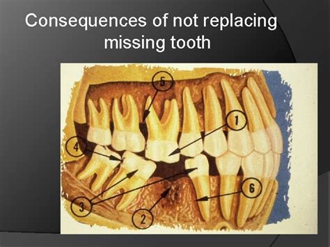 Bridge Fixed Partial Denture Fixed Dental Prosthesis Dr