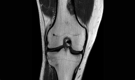 Resonancia Magnética de Rodilla con contraste PREVENTOR Ecografía