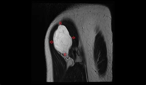 Soft tissue sarcoma MRI | Radiology article on Soft tissue sarcoma MRI