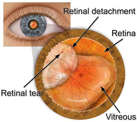 Retina Associates Of Cleveland Inc