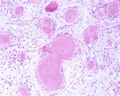 Fibroma Osificante Periférico Revisión De La Literatura Y Presentación De Dos Casos Clínicos