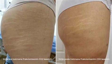 How To Get Rid Of Stretch Marks Pregnancy Stretch Marks Dermatim