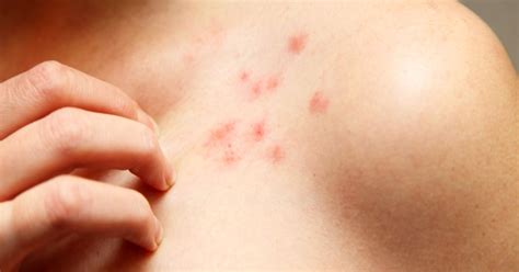 Coronavirus Chickenpox Like Rash And Other Less Talked About Troubling