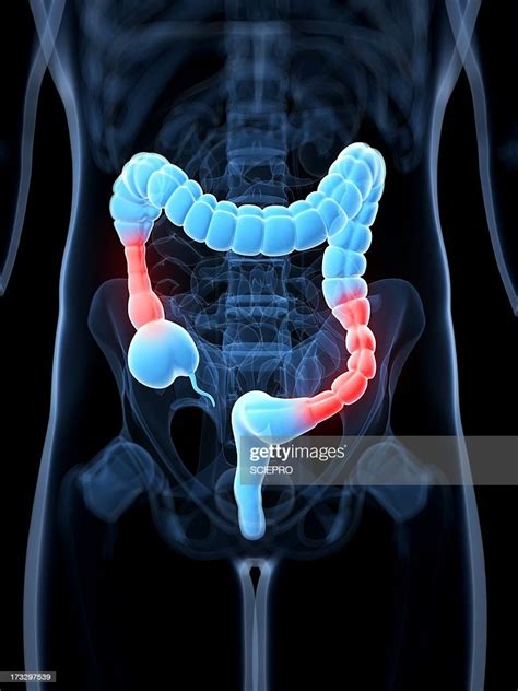 Colonic Spasm Artwork Stock Illustration Getty Images