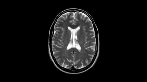 Septum Pellucidum Mri