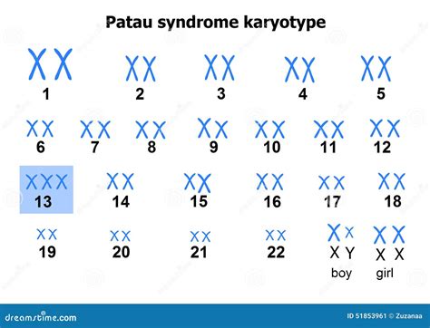 Patau Syndrome Karyotype Royalty-Free Stock Photography | CartoonDealer.com #51853961