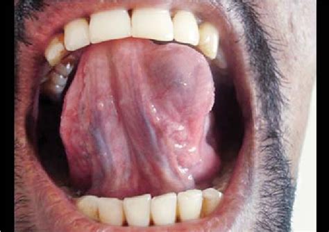 Figure 1 From Arteriovenous Malformation Of Tongue A Case Report And