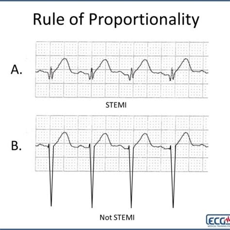 The Basics Of Paced Rhythms Ecg Medical Training