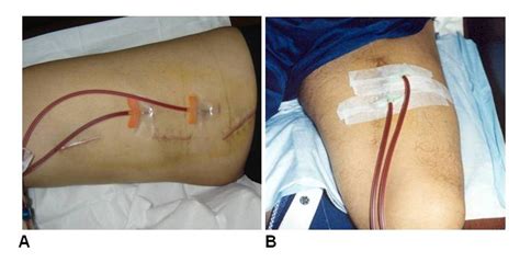 Vascular Access For Hemodialysis Overview And Emphasis On