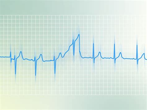 Chest Ecg Chest Ekg Stock Illustrations 161 Chest Ecg Chest Ekg Stock