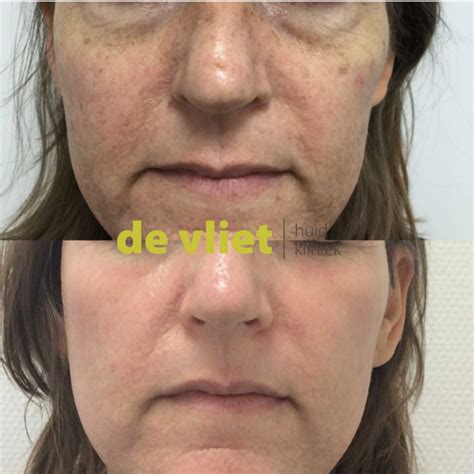 Cosmo Peel Forte Huidkliniek De Vliet is dé peeling specialist