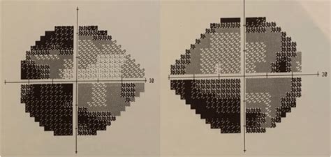 Bitemporal hemianopsia on an automated 24-2 visual field in Case 1 ...