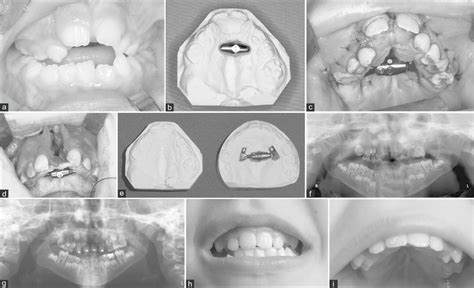 Severe Maxillary Constriction In A 6 Year Old Boy Affected By