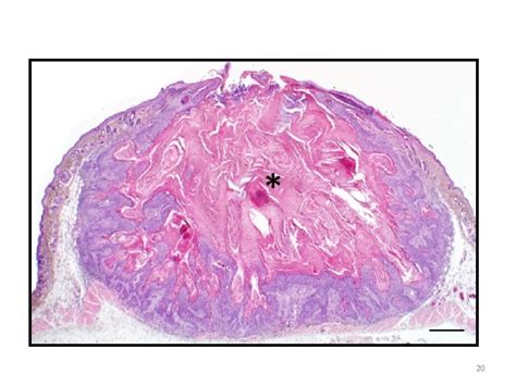 1 Benign Tumors Of Epithelial Tissue Origin Premalignant