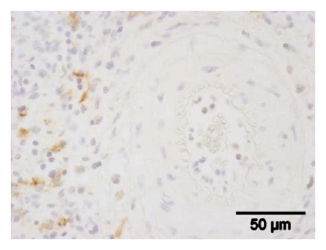 Immunohistochemical Detection Of Tgm And Cd Immunohistochemical