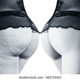 Female Buttocks Before After Cellulite Nh C S N Shutterstock