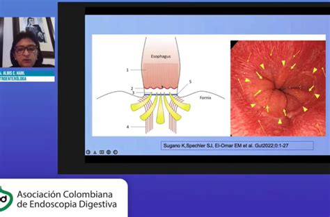 Es Fago De Barrett Valoraci N Y Tratamiento Endosc Pico Dr Alberto