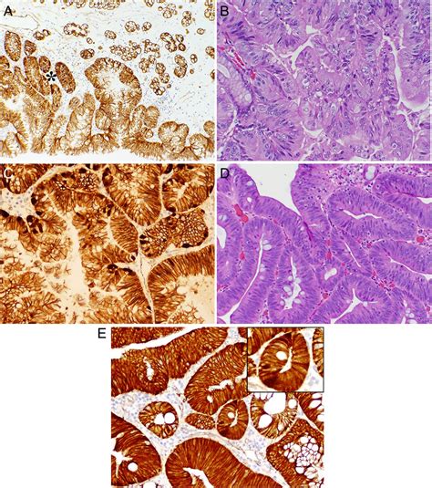 β Catenin activation in fundic gland polyps gastric cancer and colonic