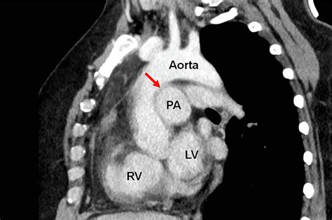 Computed Tomography Ct Scan Of The Chest The Sagittal Ct Image Shows