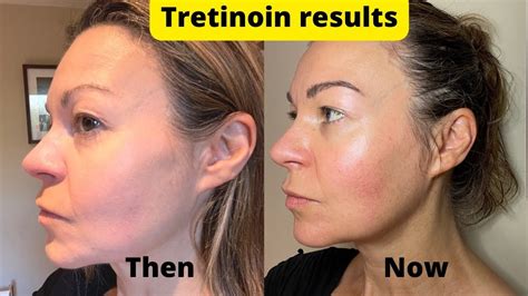 Dermatica Tretinoin 6 Month Results Update Plus How To Manage Sun