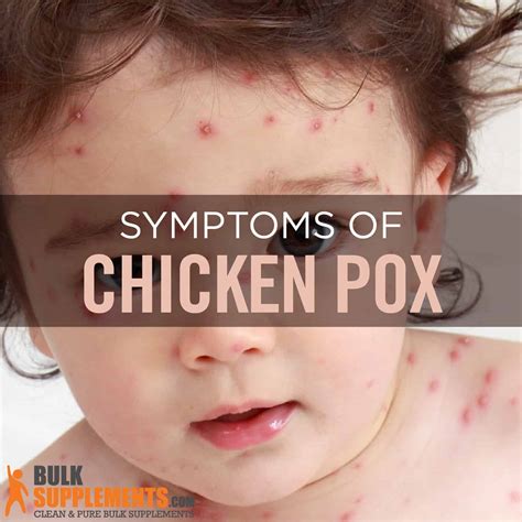 Chickenpox Rash