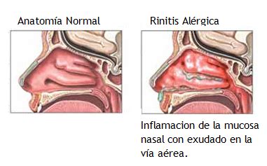 Blog M Dico De Isaa Rinitis Al Rgica