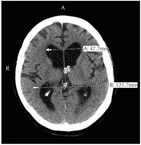 Mri Of A Patient With Probable Idiopathic Normal Pressure Download Scientific Diagram