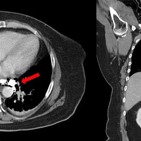 Laparoscopic Treatment Of The Distal Iatrogenic Esophageal Perforation