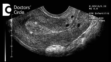 Does A Thick Uterine Lining Mean Pregnancy - PregnancyWalls