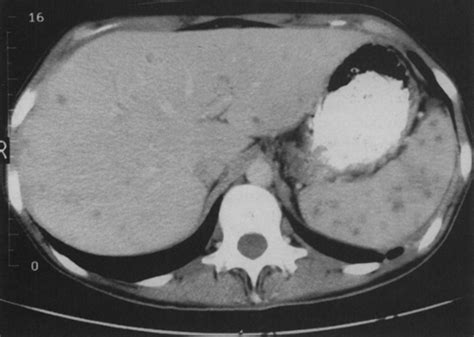 The Liver Biliary System And Pancreas Radiology Key