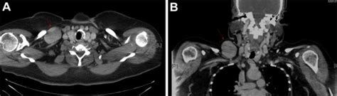 Blunt Traumatic Subclavian Vein Pseudoaneurysm Journal Of Vascular Surgery Cases