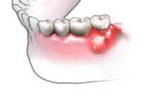 10 Causes of Inflamed Gums