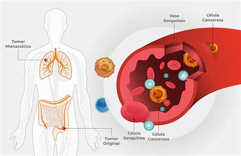 El cáncer metastático colorrectal puede diseminarse al principio