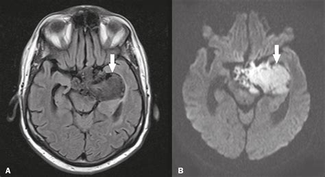 Arachnoid Cyst Mri