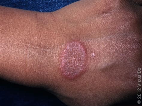 Ringworm Vs Eczema Telling The Difference With Pictures Goodrx