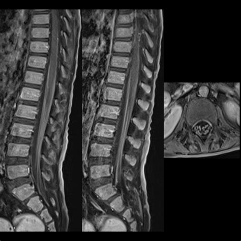 Pediatric Guillain Barre Syndrome Pediatric Radiology Reference