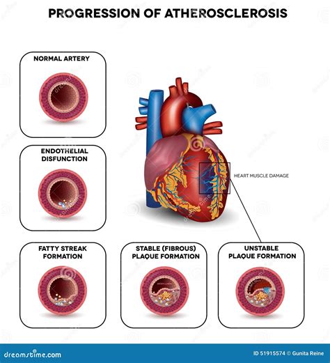 Stages Of Atherosclerosis Cartoon Vector | CartoonDealer.com #86262433