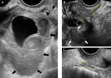 A Transvaginal Sonography Tvs Presents A Sizable Right Sided Ovarian